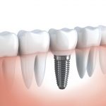 Implanty zębów – czy mogą nam zastąpić prawdziwe zęby?