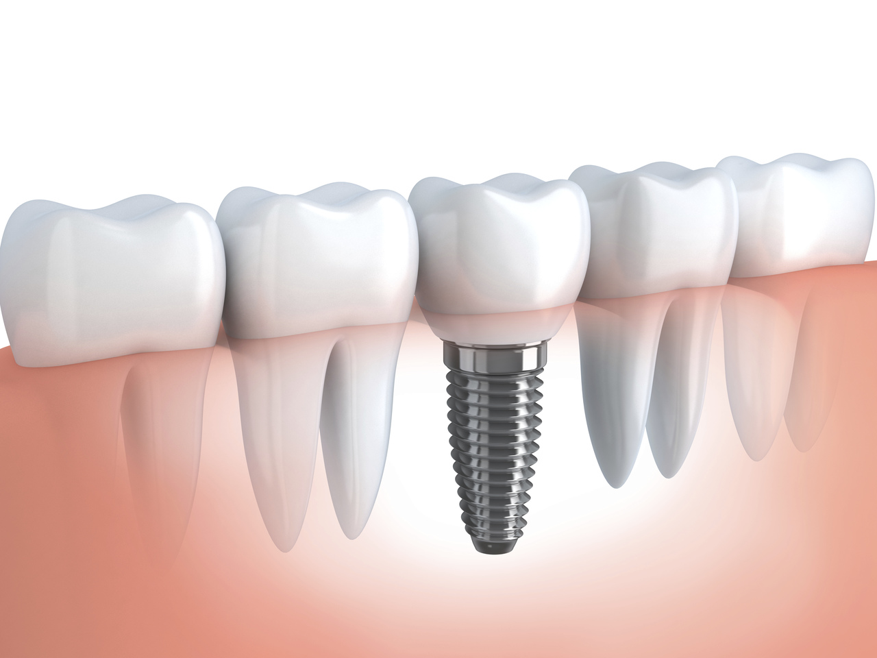 Implanty zębów – czy mogą nam zastąpić prawdziwe zęby?