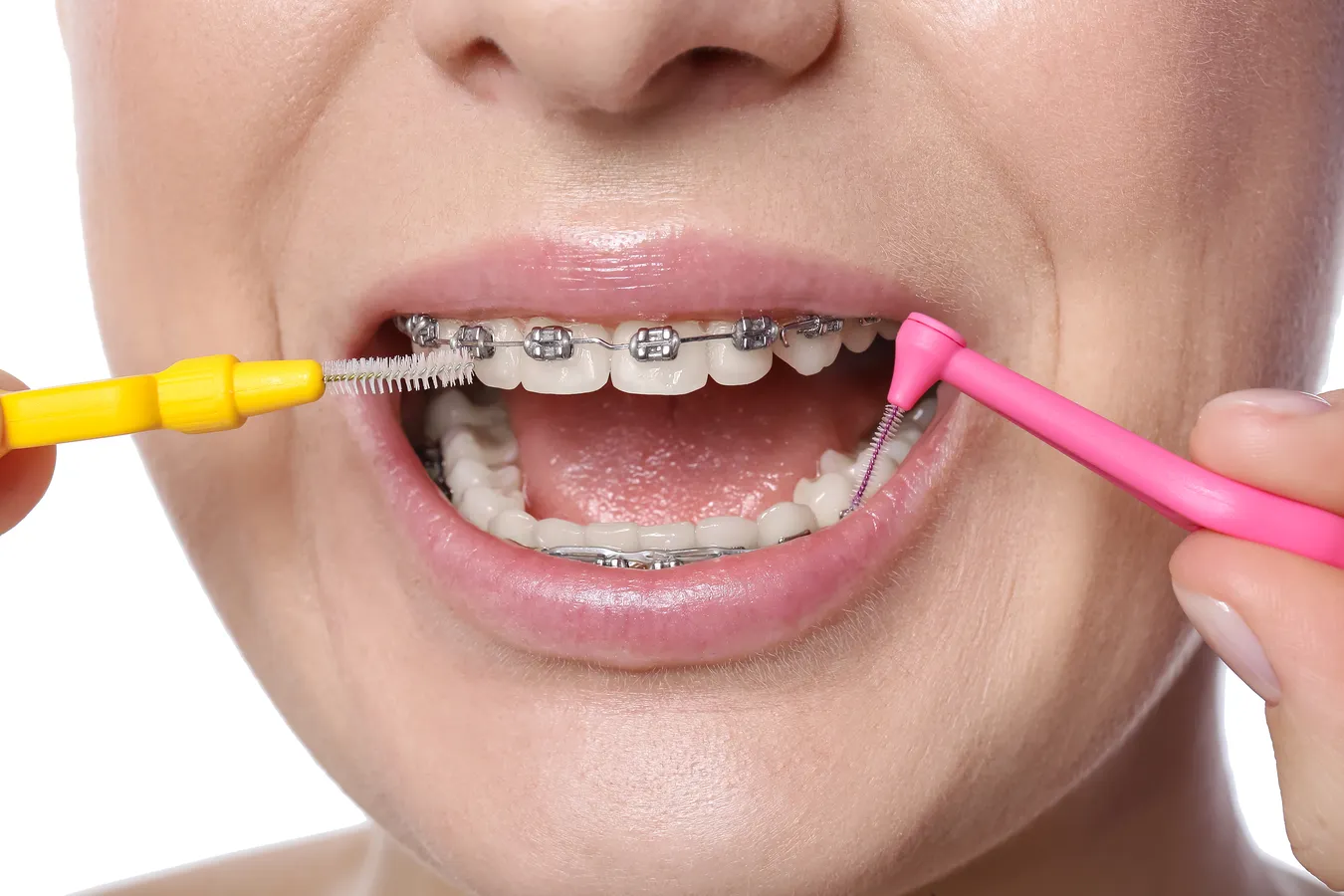 Na czym polega kanałowe leczenie zęba?